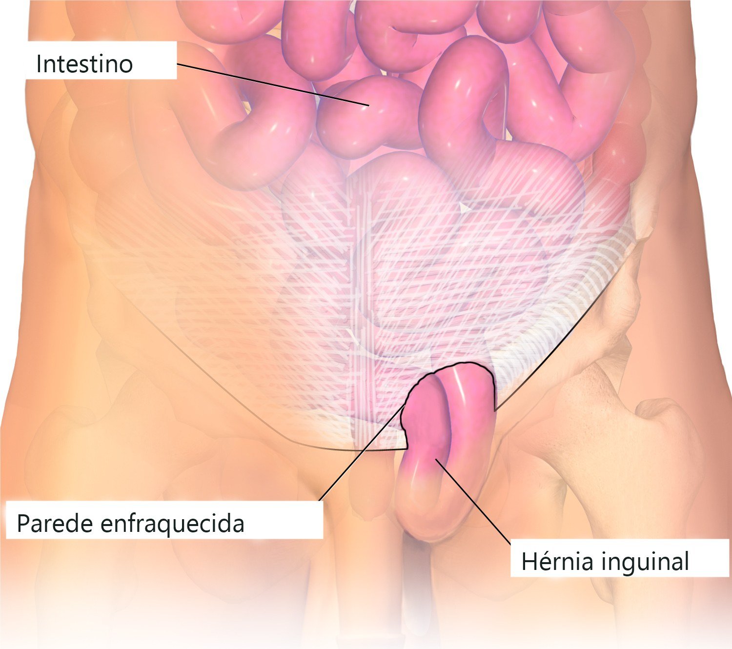 Ilustração da região inguinal mostrando uma alça de intestino atravessando um ponto enfraquecido da parede abdominal e formando a hérnia na virilha.